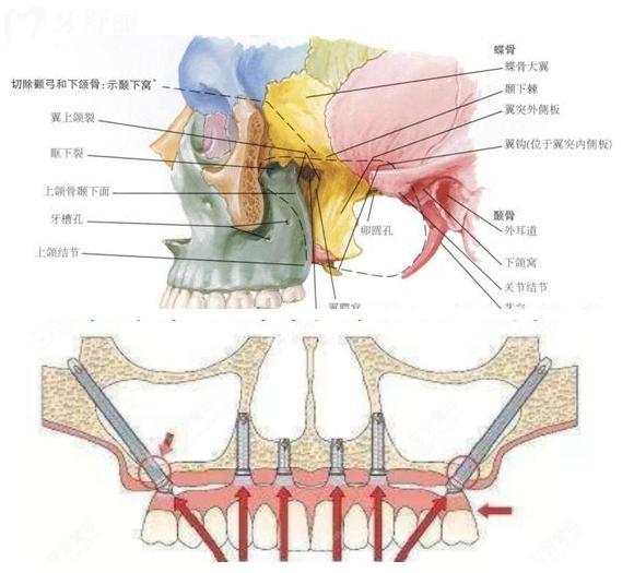 VIIV缺骨植