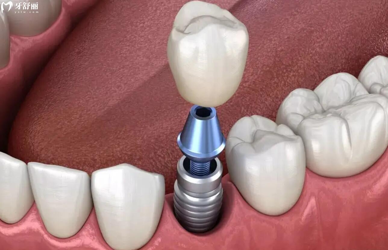 数字化牙齿种植技术