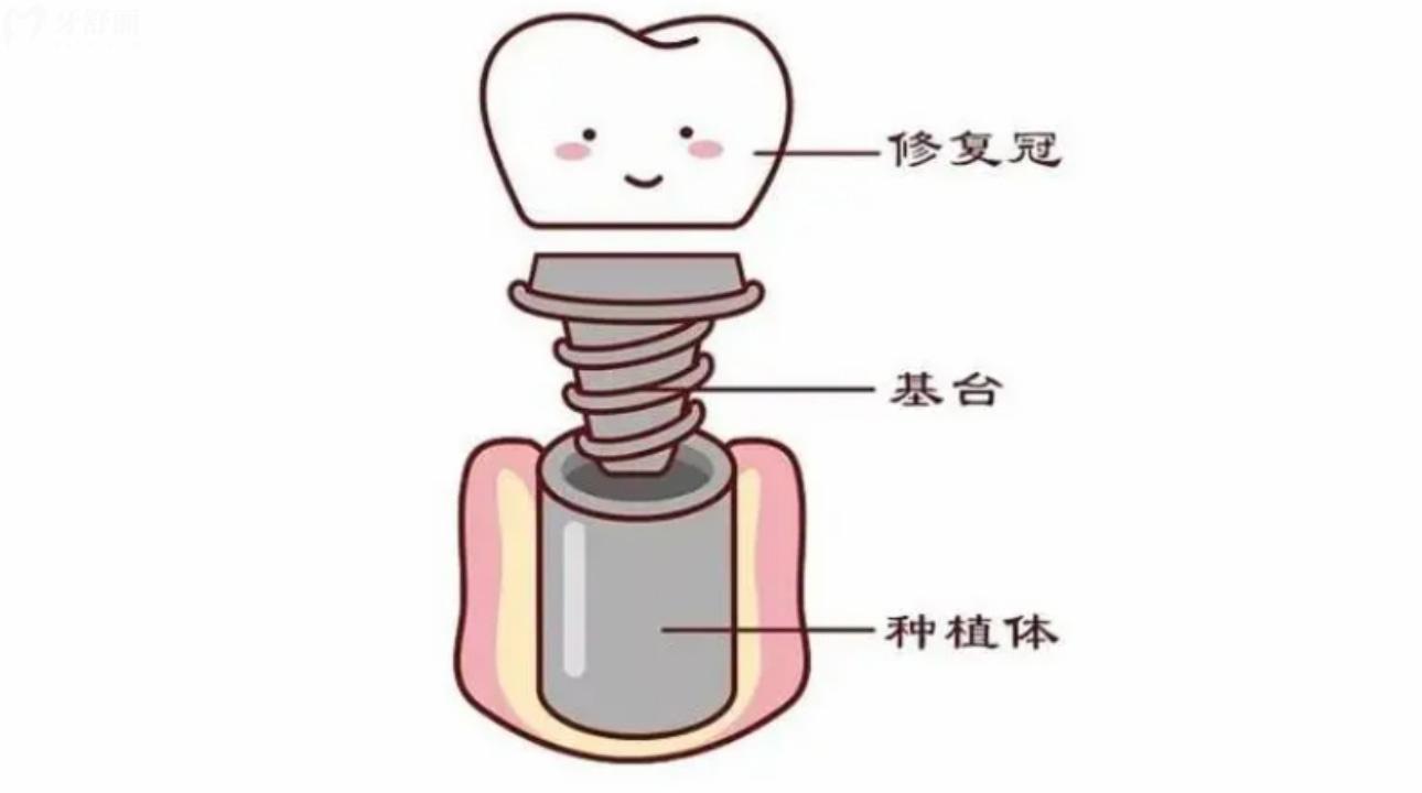 以色列丹特因Dentin种植体