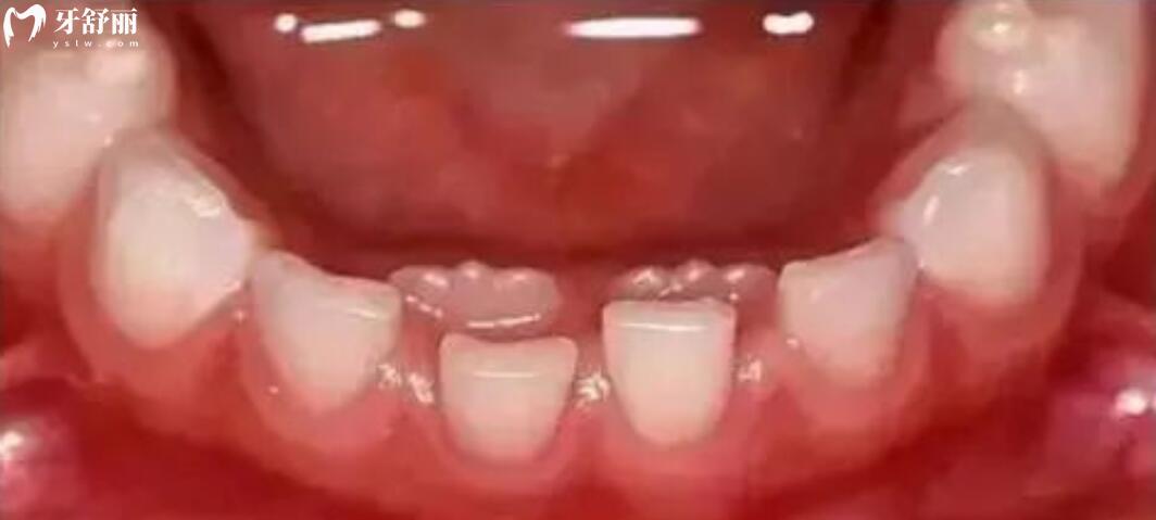 6岁小孩下门牙长了双层牙怎么办？
