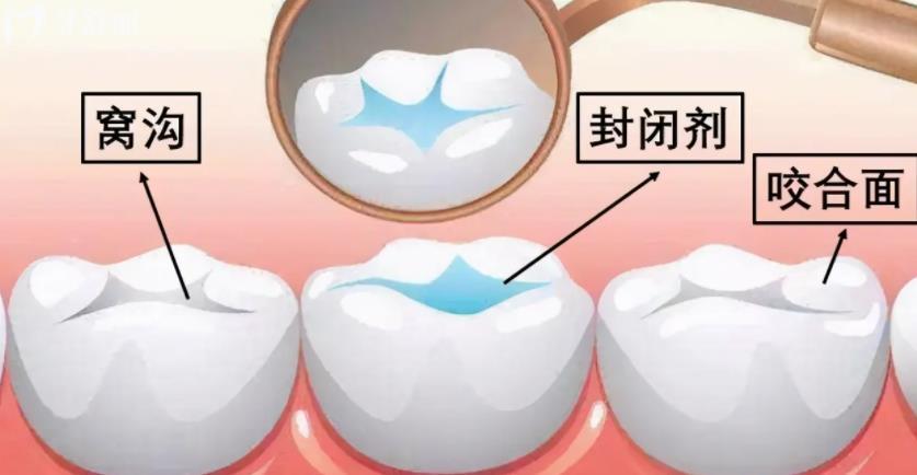 家长注意啦！孩子这颗牙一生不会换现在保护来得及