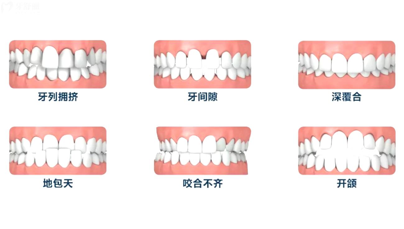 北海牙齿矫正大概要花费多少钱.jpg