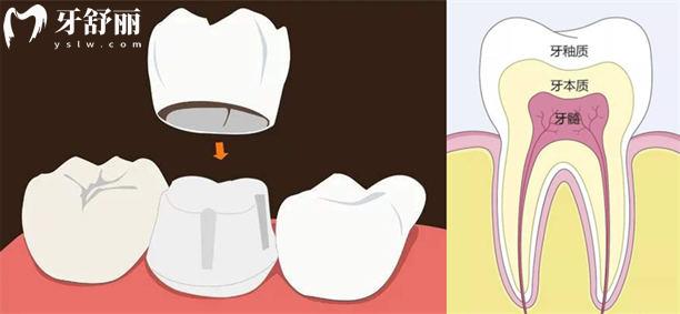 全瓷冠和烤瓷冠应该怎么选？各项优缺点对比你就明白了