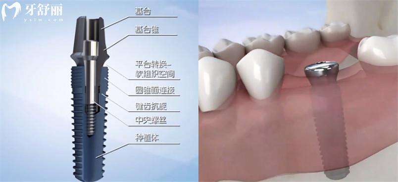 宜宾口腔收费标准 宜宾补牙多少钱一颗 宜宾种植牙多少钱一颗 宜宾牙齿矫正怎么收费