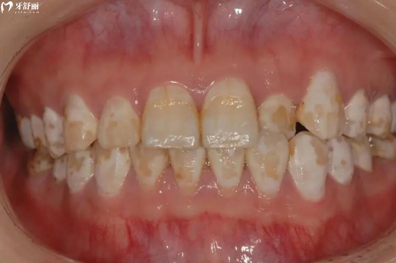 四环素牙和氟斑牙的区别是什么?突然发现牙齿有个黄色斑