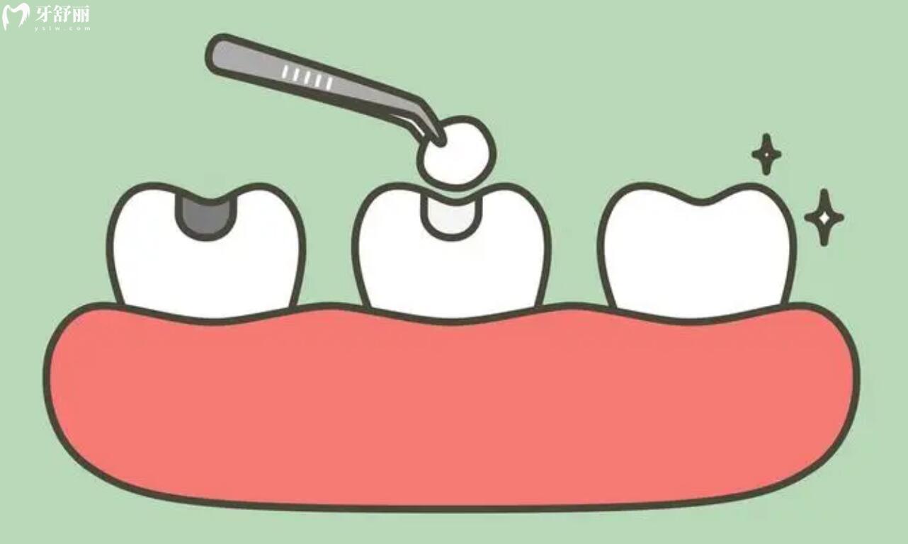 补牙后口腔溃疡怎么回事？补牙和口腔溃疡有关吗