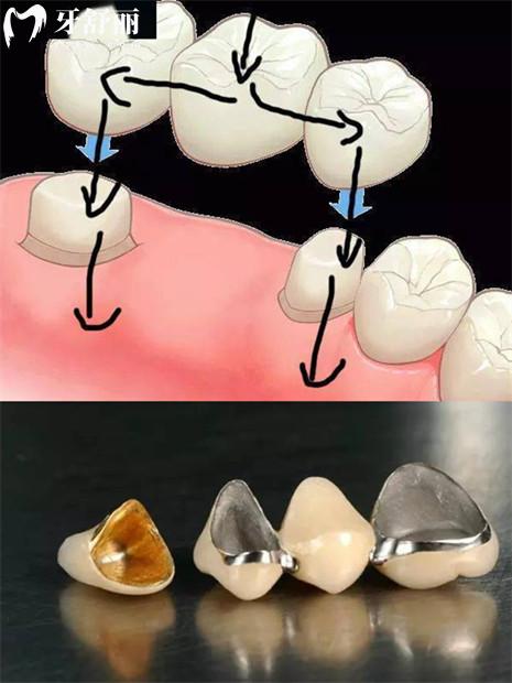 固定桥镶牙图片