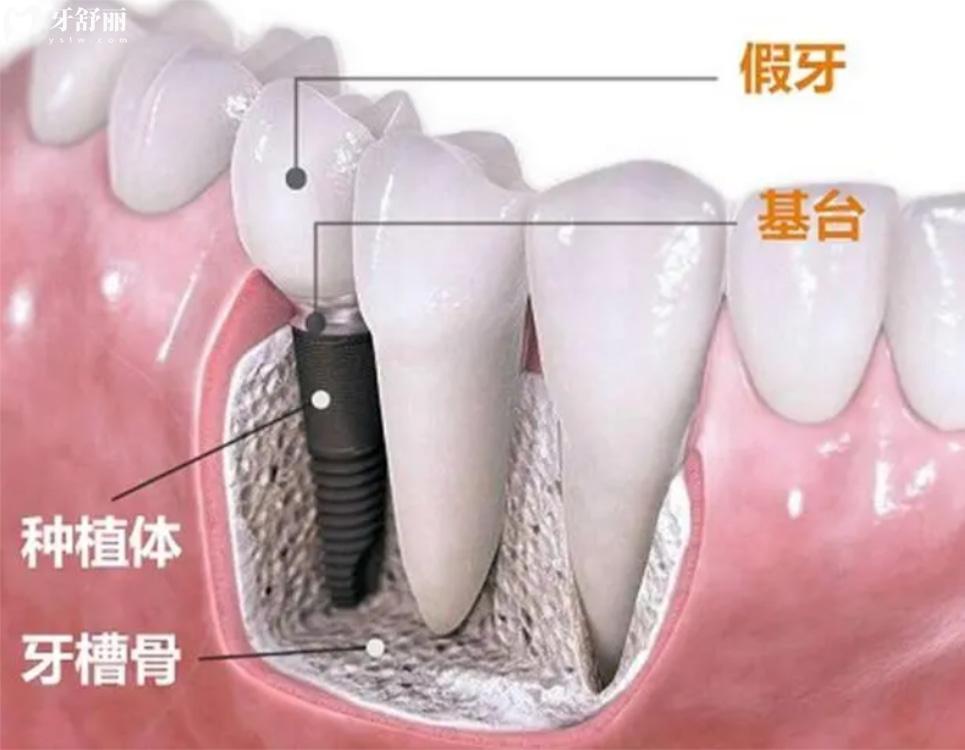 孝感种植牙多少钱一颗.jpg