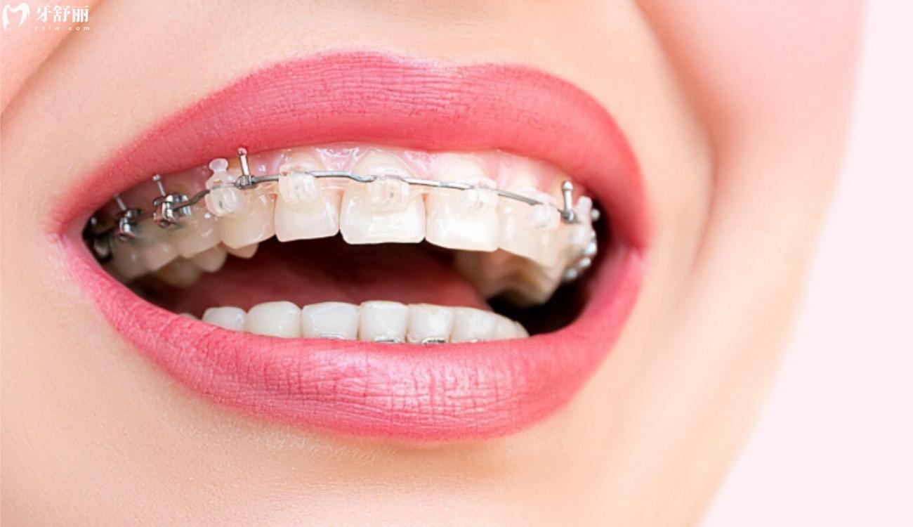 牙齿矫正器 类型图片