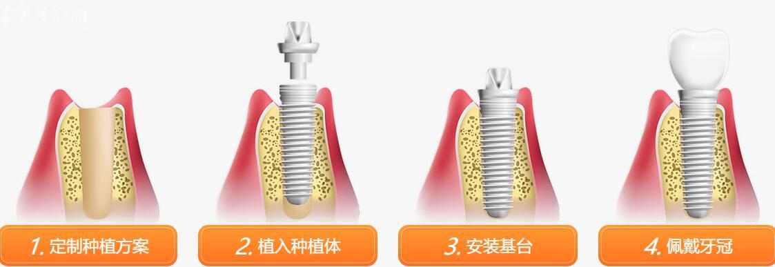 瑞典Nobel诺贝尔种植牙怎么样