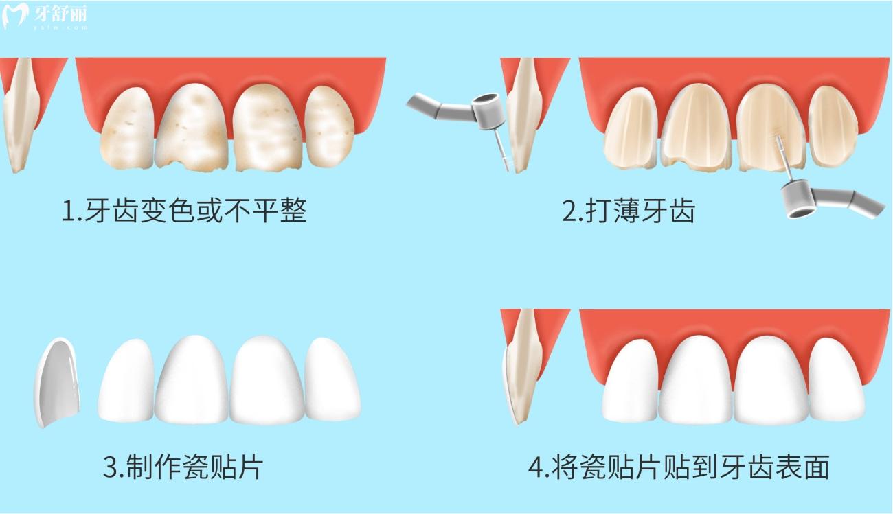 门牙从侧面掉了一半能补上吗.jpg