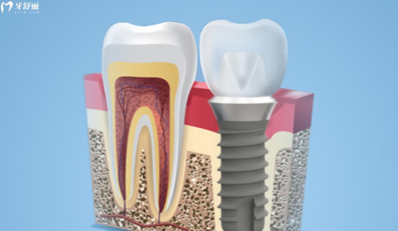 广慈ZDI人工种植牙怎么样.jpg