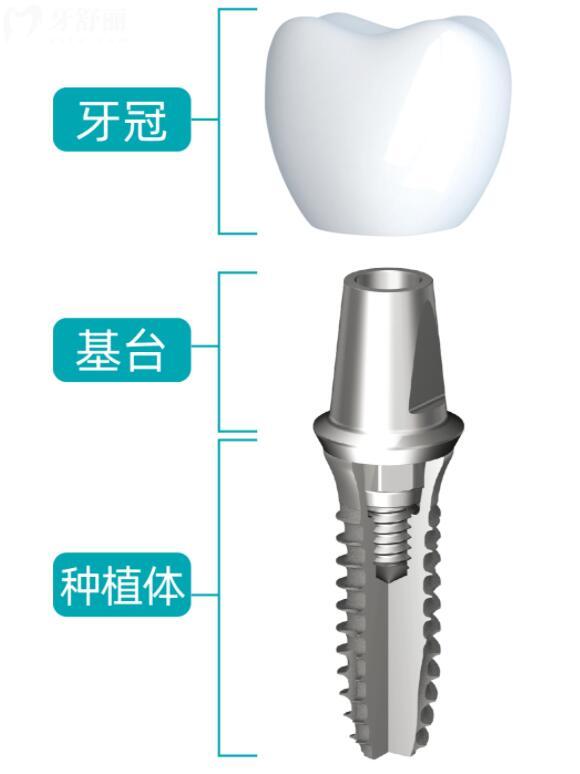 德国卡姆洛种植体