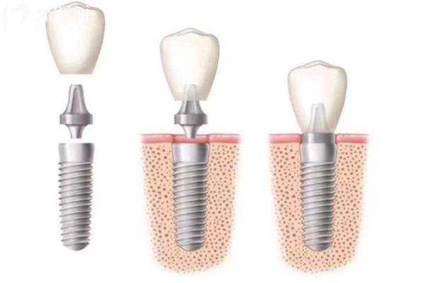 种植牙示意图.jpg