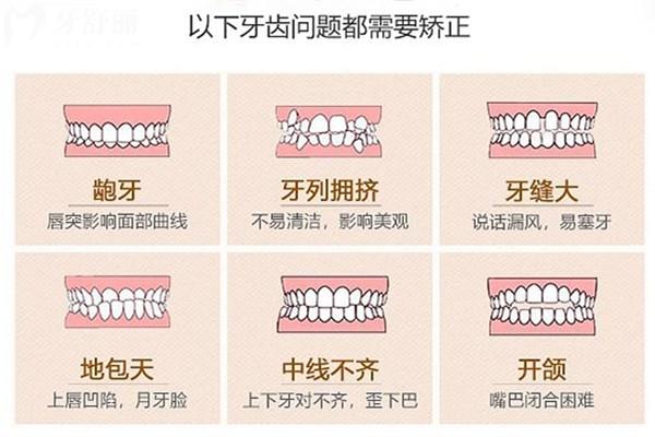 牙齿需要矫正的问题