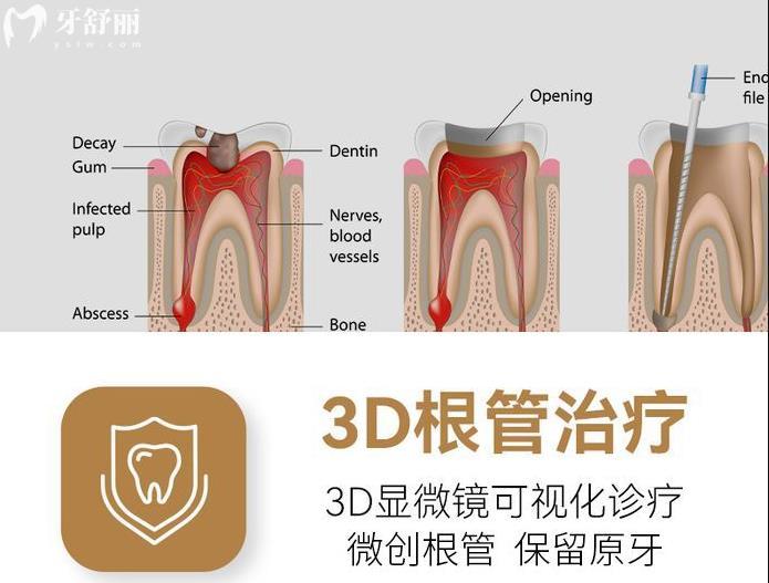 根管治疗