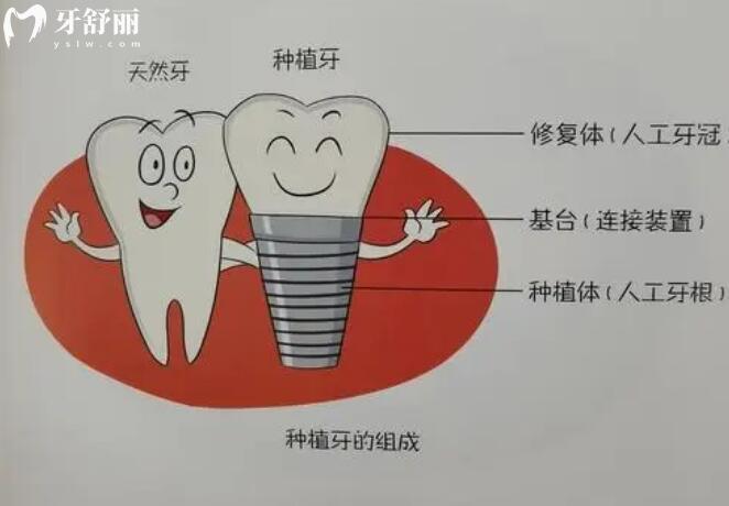 种植牙价格