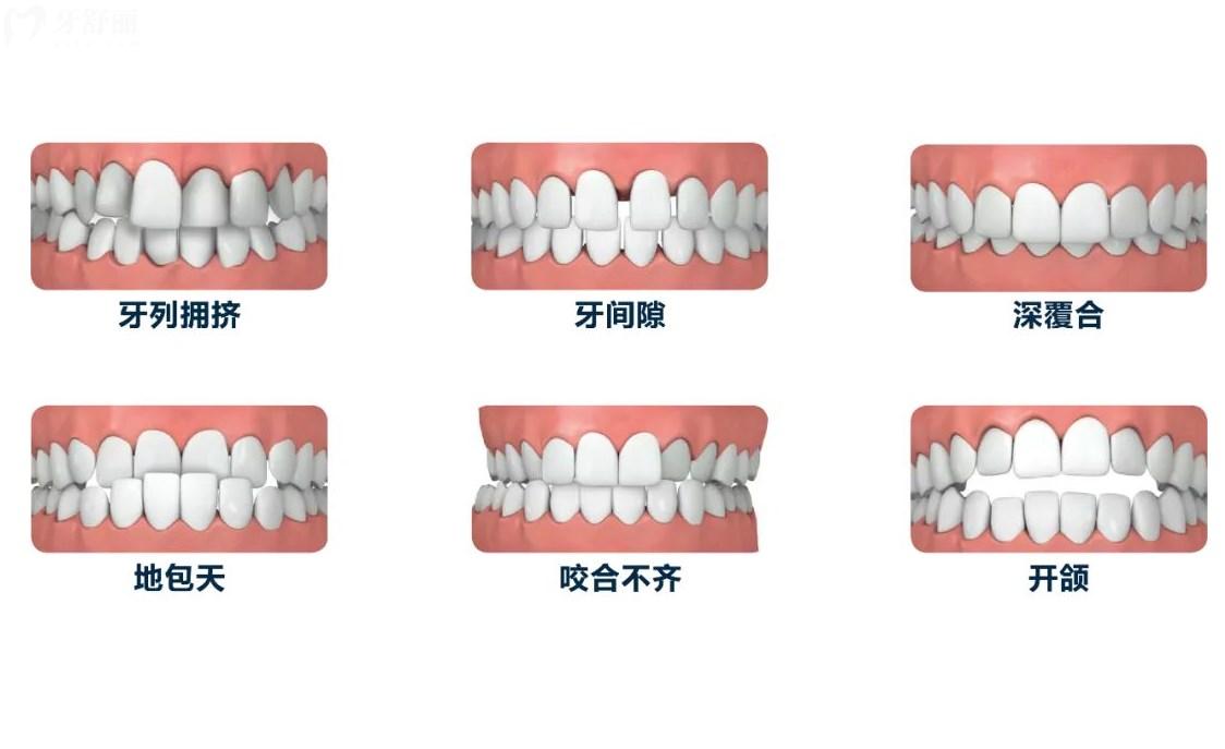 哪些牙齿需要做矫正