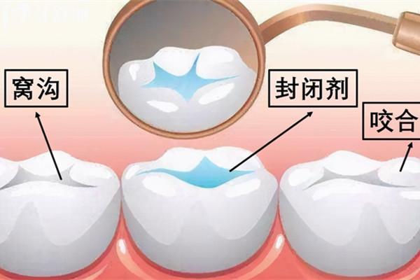 儿童窝沟封闭