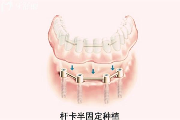杆卡半固定种植牙