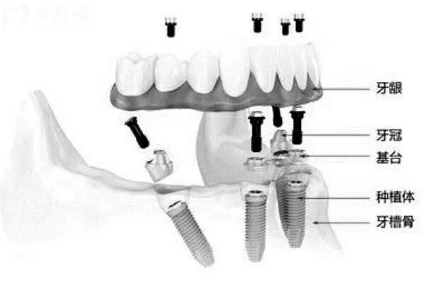 上海种植牙价格一般多少钱2024?1颗2580+半口2万+全口5万+