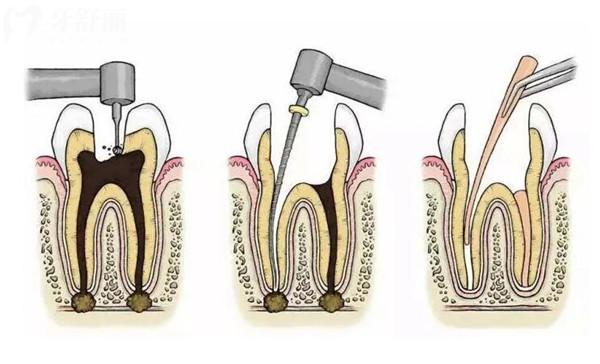 根管治疗