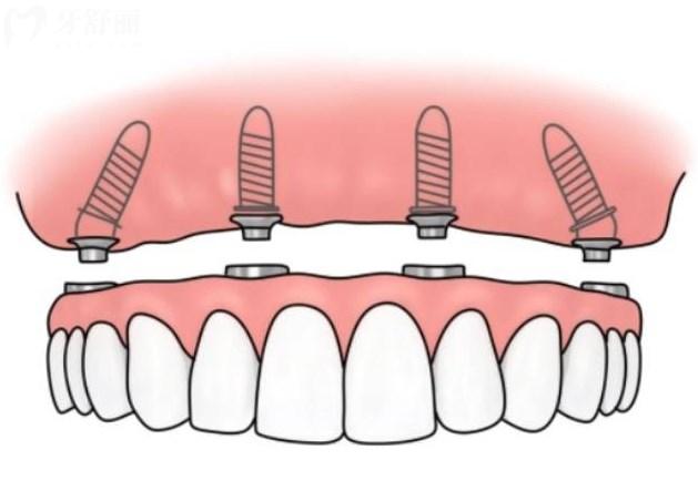全口种植牙