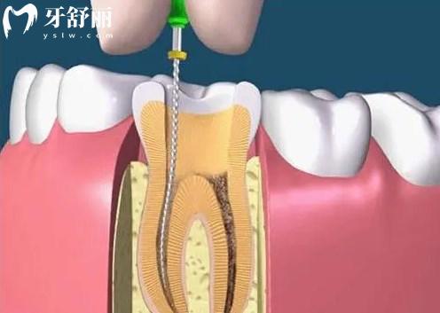 根管治疗