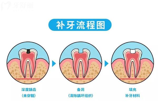 补牙流程图