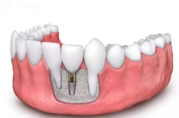 天津塘沽口腔医院种植牙价格表
