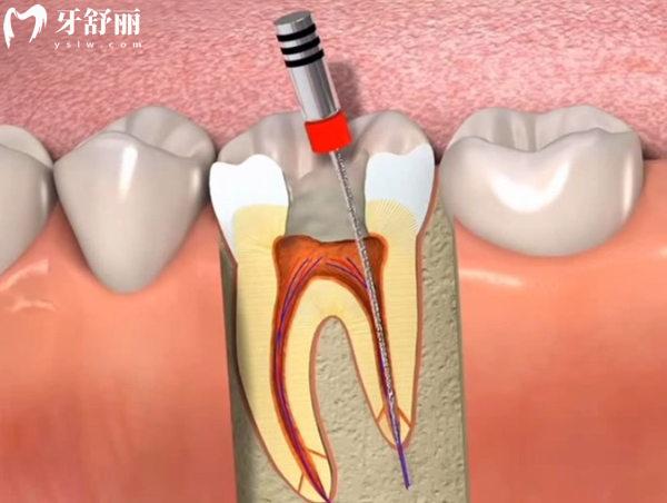 根管治疗图