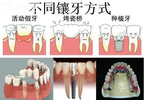 镶牙方式对比