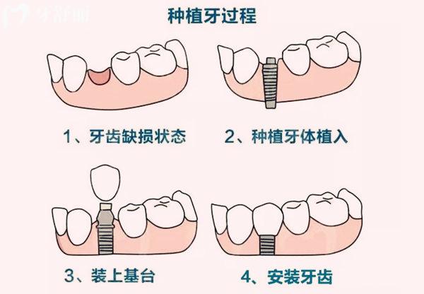 种植牙过程