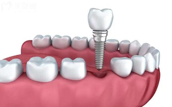 天津**种植牙价格