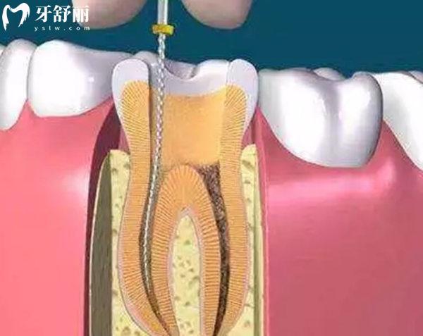 石家庄根管治疗价格