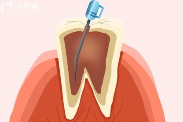 淳安根管治疗价格