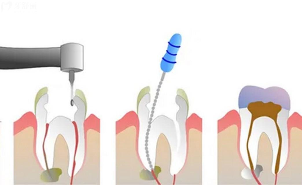 根管治疗