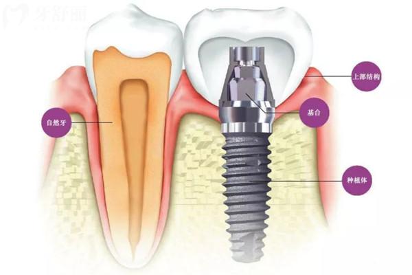 种植牙结构图