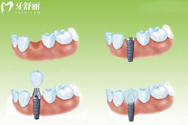种植牙过程