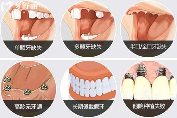 种植体适用人群