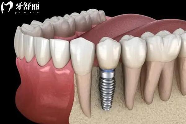 2023象山种植牙价格