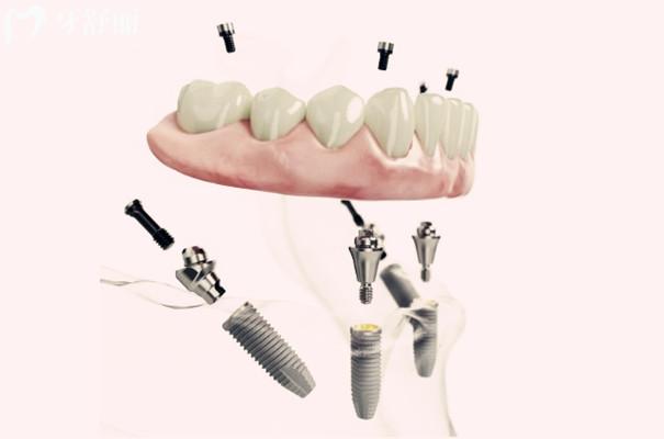 天津医科大学口腔医院种植半口牙多少钱