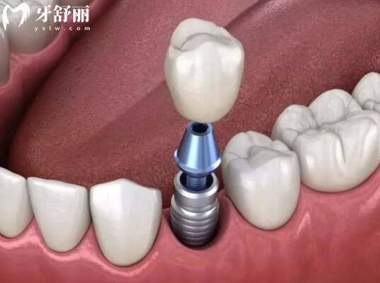 惠州新惠口腔医院价格表更新,种植牙2380+,矫正5500+收费实惠