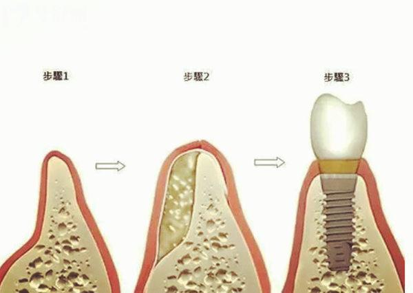 秦皇岛种牙价格表