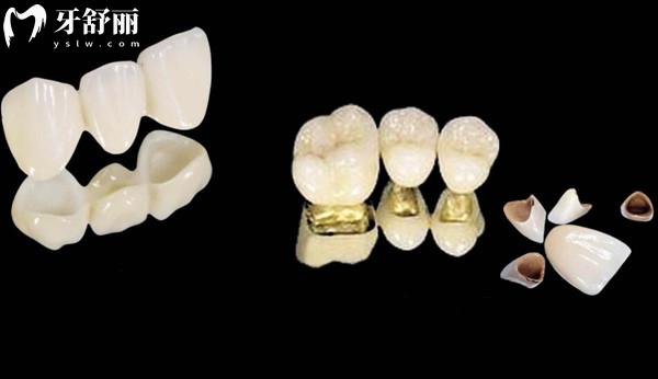 缺牙危害不可忽视!四种适合不同缺牙人群修复方式,教你如何选