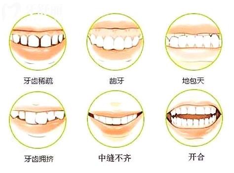 正畸后为什么会反弹？先了解原因才能有效的避免反弹