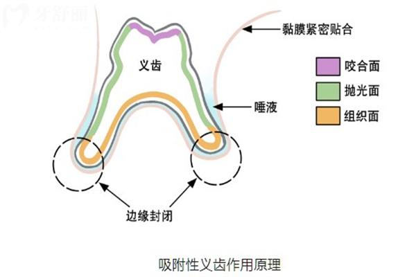 吸附性义齿