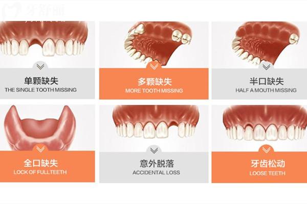 内江种植牙多少钱一颗