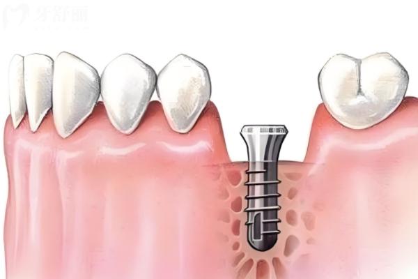 种植牙.jpg