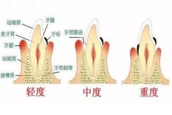 牙龈萎缩不同程度对比